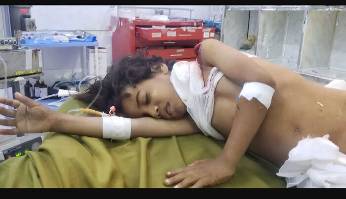 بتر رجلي طفلين بسبب قذيفة حوثية استهدفت حيًا سكنيًا في تعز