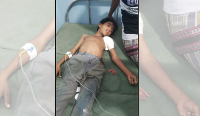 إصابة طفل برصاص مليشيا الحوثي في حيس غربي اليمن