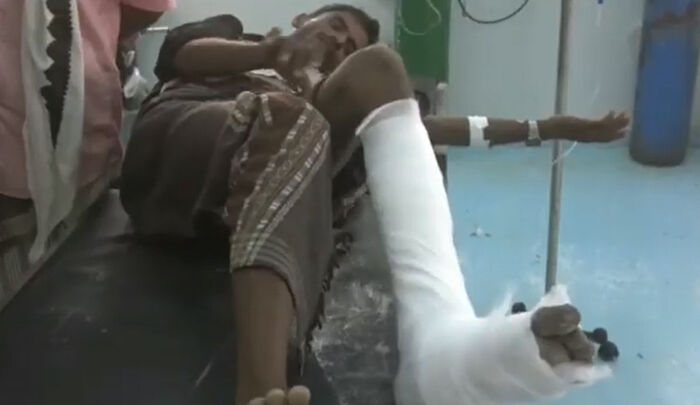 إصابة مواطن يمني بلغم حوثي في حيس غربي اليمن
