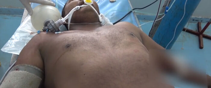 إصابة مواطن بإنفجار لغم حوثي في الحديدة