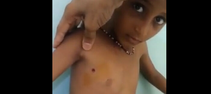 استشهاد طفل وإصابة شقيقته بانفجار قنبلة من مخلفات الحوثيين في حيس