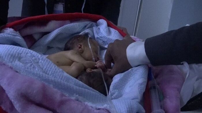 ميليشيا الحوثي ترفض سفر توأم سيامي للعلاج