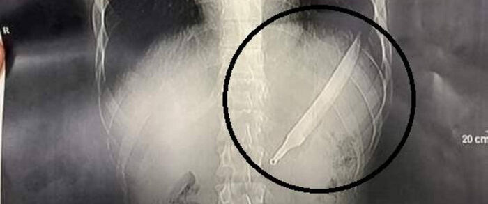 مصري يبتلع سكينا طوله 27 سنتيمترا.. والأطباء يصنعون معجزة