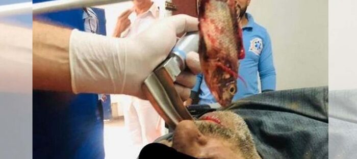 استخراج سمكة حية من القصبة الهوائية لصياد مصري.. كيف ابتلعها؟