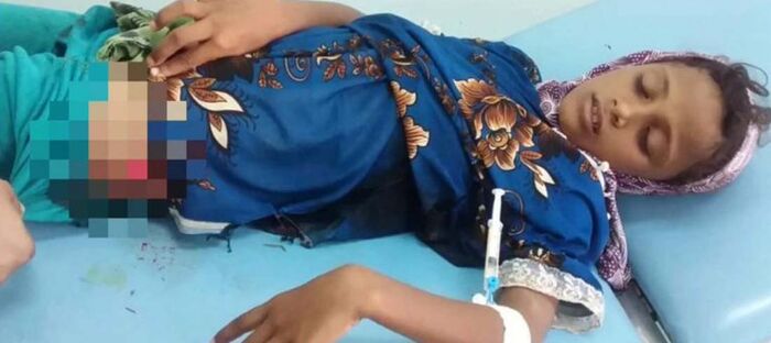 إصابة طفلة بنيران قناصة مليشيا الحوثي في الجبلية غربي اليمن