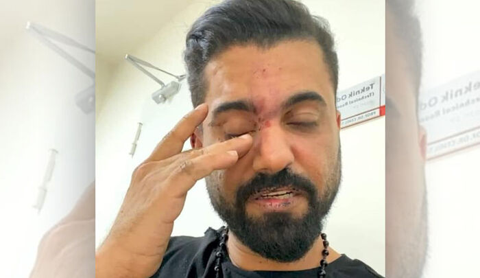 فنان يمني يتعرض للضرب في تركيا