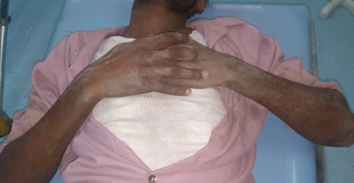 إصابة مدني بانفجار لغم من مخلفات الحوثيين في الخوخة غربي اليمن