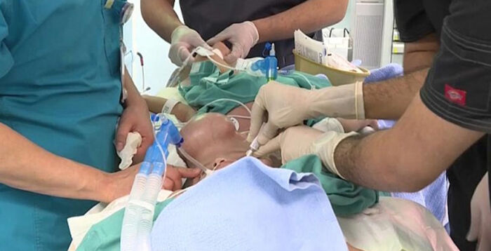 وفاة أحد توأمين يمنيين سياميين غداة عملية لفصلهما في السعودية