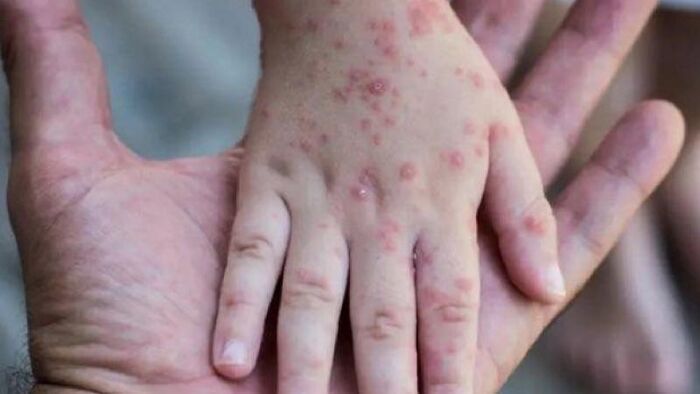 «الصحة العالمية»: 18 ألف إصابة بجدري القرود في 78 دولة