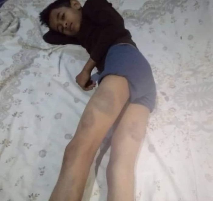 مدير مدرسة حوثي يعتدي بالضرب المبرح على طفل في إب