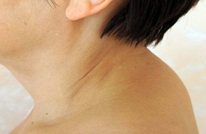 أسباب ظهور «سنام الأرملة» لدى النساء بعد انقطاع الطمث