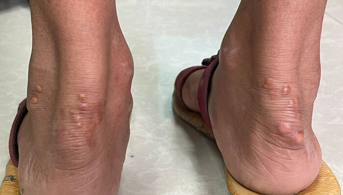 علامة في أصابع القدم تدل على ارتفاع الكولسترول الخبيث
