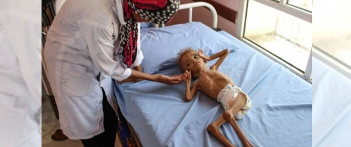 مسئول أممي: عودة شبح المجاعة بسبب الحوثيين